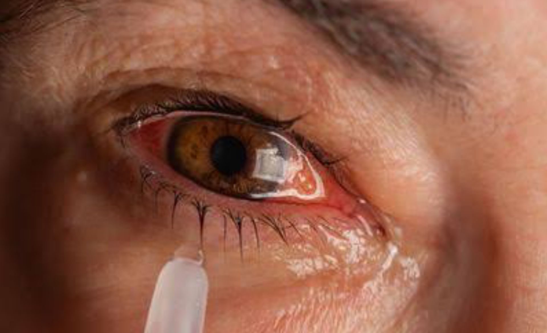 बच्चों की आँख में कीचड़ आना: Effective 5 Methods